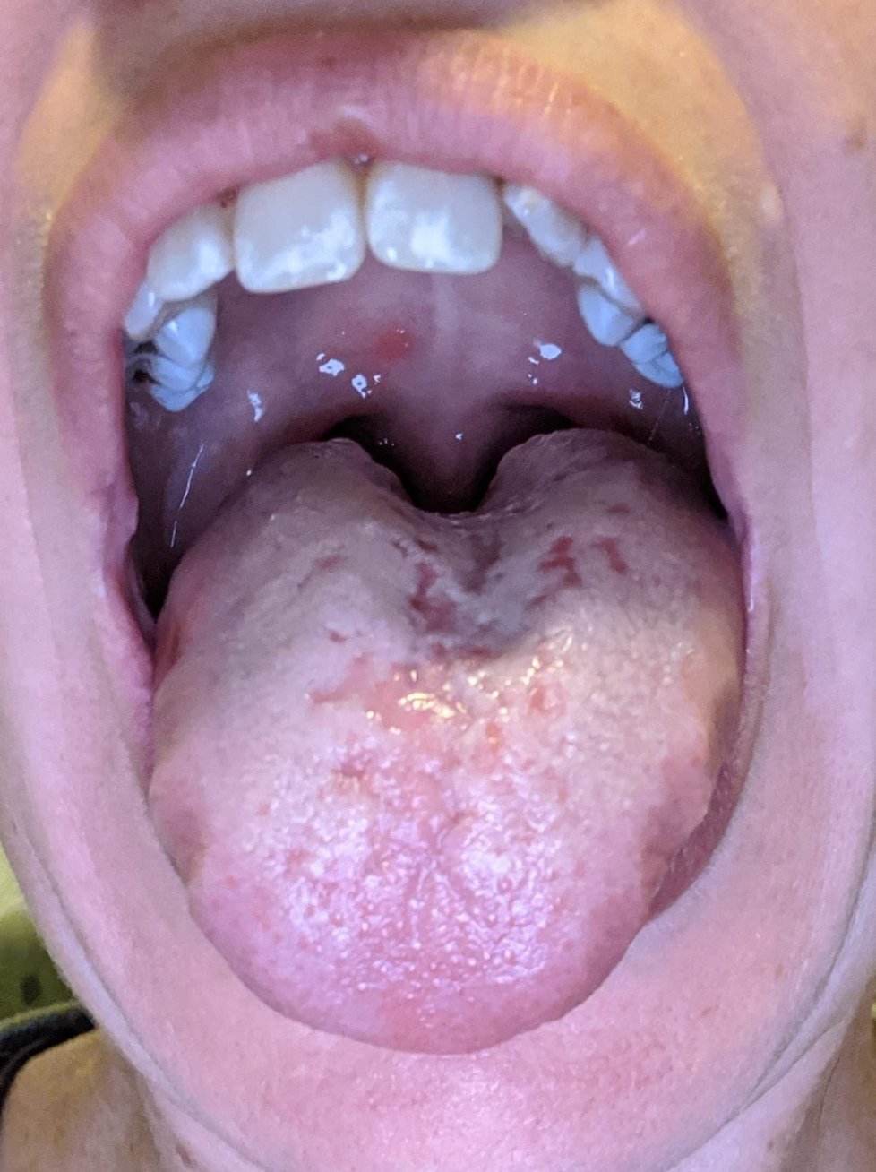 Pacienti s covidem-19 sdíleli na twitteru epidemiologa jeden z možných příznaků nákazy - covidový jazyk