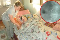 Stařenka trpí s jehlou v břiše: Zapomněli ji tam při operaci doktoři