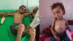 Tisíce jemenských dětí trpí hladomorem.
