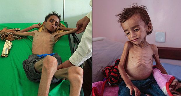Smrt lepší než hlad. Zbídačení Jemenci se radši zabijí, než aby vyhladověli