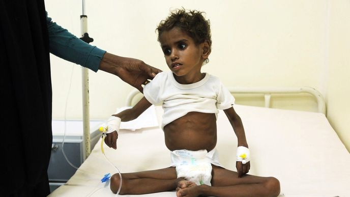 Hladomor v Jemenu.