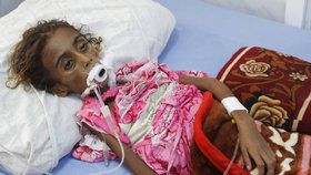 Srdceryvné foto: Sedmiletá Jemenka zemřela na podvýživu.