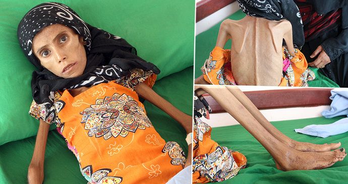 Katastrofální dopad války v Jemenu: Dvanáctiletá Fatima trpí extrémní podvýživou.