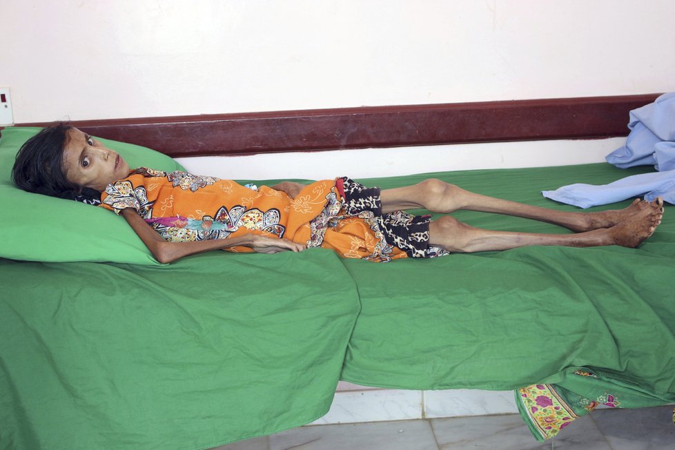 Katastrofální dopad války v Jemenu: Dvanáctiletá Fatima trpí extrémním podvýživou.
