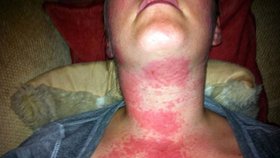 Alergickou reakci ženy způsobil nejspíš silikon v pouzdře