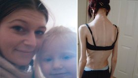 Zpověď anorektičky: Dítě mě vyrvalo ze spárů smrti!