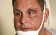 Nad dobře maskovaným obličejem Michala Novotného se pozastavovali i doktoři
