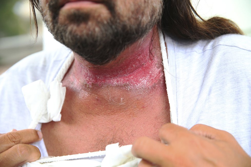 Po 33 ozařováních měl herec popálený krk.
