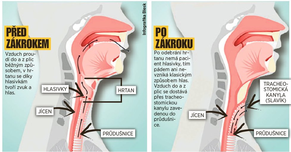 Operace nádoru hrtanu – před a po zákroku