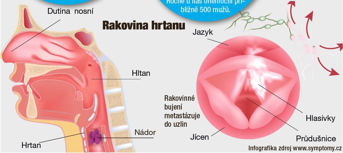 Rakovina hrtanu