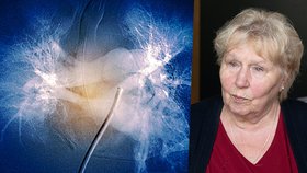Paní Jiřina (75) má srdeční chorobu, pomohla jí moderní léčba