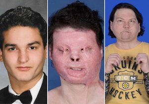 Joe DiMeo je prvním člověkem, kterému byly úspěšně transplantovány obě ruce i obličejem.