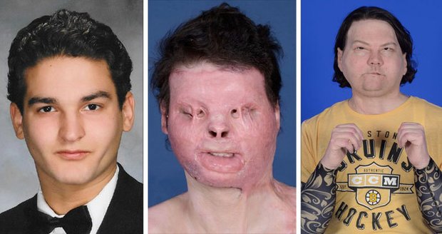 Šance na nový život: Znetvořenému muži po nehodě poprvé transplantovali obličej i ruce