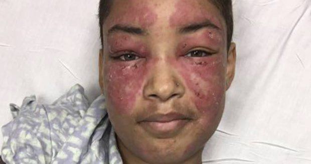 Alergie na světlo jí ničí tvář i život! Lékaři si neví rady