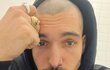 Muzikant Jordan Haj šel do hola kvůli onemocnění zvané alopecie.