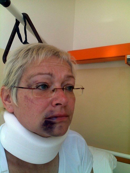 Darina Nová si odnesla z incidentů s exmanželem Josefem několik ošklivých poranění.