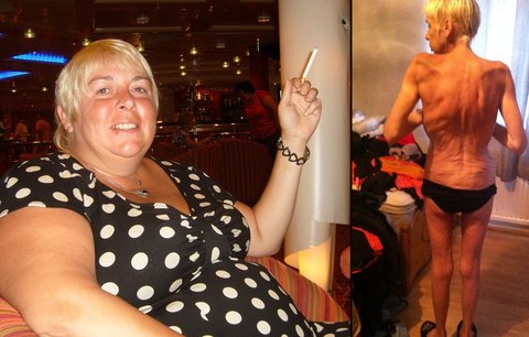Po nevydařené operaci zhubla Julie 92 kilo: Denně musí sníst 5000 kalorií, nebo zemře!