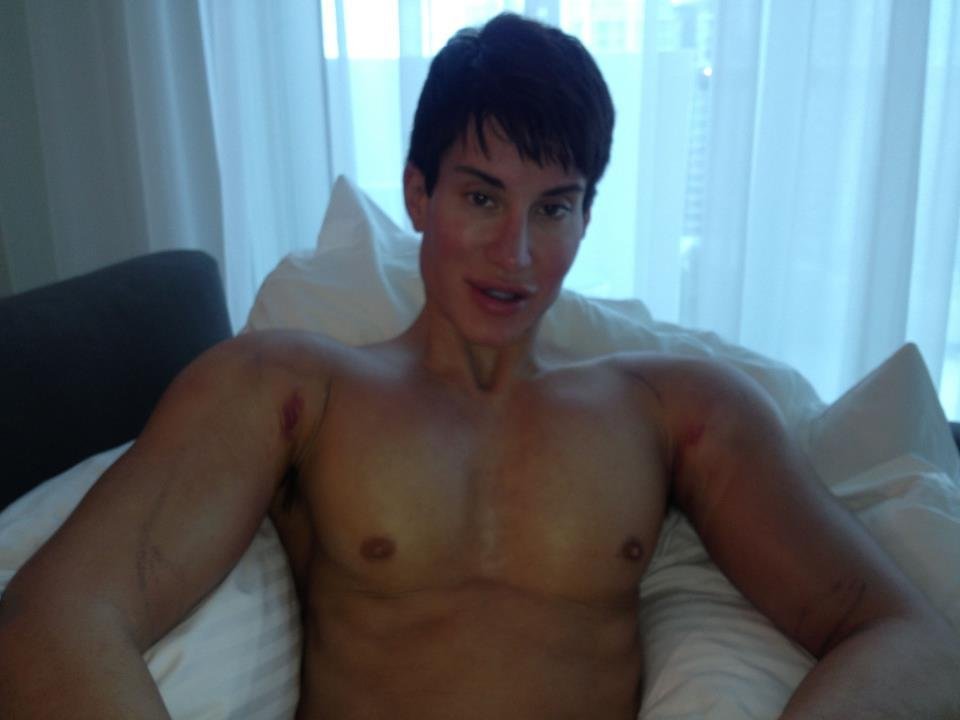 Justin Jedlica si nechal voperovat silikony do bicepsů