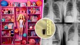 Lékaři hledali příčinu jejích potíží: V plicích našli 51 let starou hračku