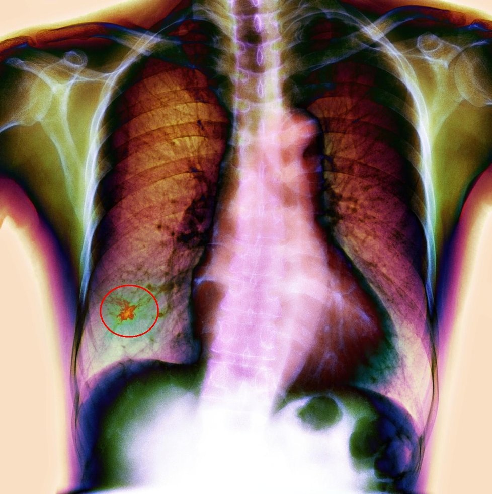 Rentgenový snímek rakoviny plic se zřetelným karcinomem