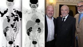 Nová léčba vyléčí rakovinu, jakou měl i Karel Gott, do tří měsíců.