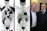 Naděje pro nemocné jako Karel Gott: Takhle rakovina zmizí za 3 měsíce