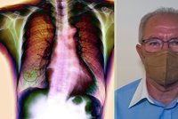 Nenápádný zabiják: Rakovina plic se Karlovi (64) ohlásila bolestí ramene