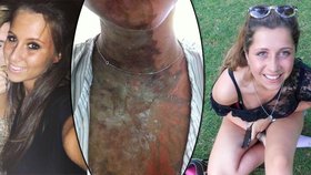 Osmnáctileté dívky skončily po útoku kyselinou s vážnými popáleninami