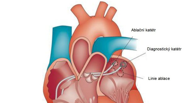 Katetrizační ablace: operace srdce
