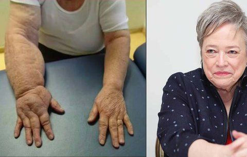 Oscarová herečka si nechala odstranit prsa a z ruky se stala tlapa!