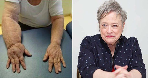 Oscarová herečka si nechala odstranit prsa a z ruky se stala tlapa!