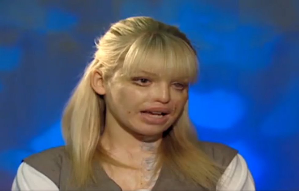 Katie Piper o útoku dokáže už mluvir