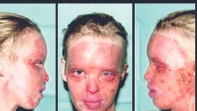 2009 - Katie zůstala po útoku kyselinou sírovou zjizvená tvář, navíc ztratila možnost vidění na levé oko.