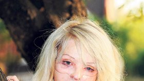 2008 - Někdejší modelka musela nosit 23 hodin denně speciální masku, která jí natahovala tkáň na tváři