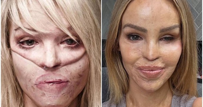 Kvůli žárlivosti jí bývalý přítel znetvořil tvář kyselinou: Jak vypadá modelka dnes?