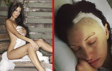 Modelka z Playboye si po operaci mozku stěžuje: Změnili mi osobnost!