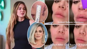 Khloé Kardashianová (39) po operaci nádoru na obličeji: Zdeformovaná tvář! Musí ji vyplnit injekcemi