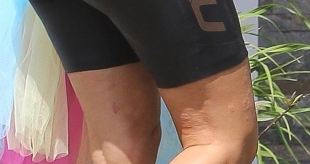 Pohled na nohy Kim Kardashianové odhalil vyrážku kvůli lupénce