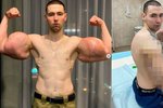 Kiril Těrešin se chystá na komplikované odstranění obrovských „bicepsů“.
