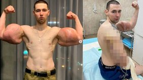 Kiril Těrešin se chystá na komplikované odstranění obrovských „bicepsů“.