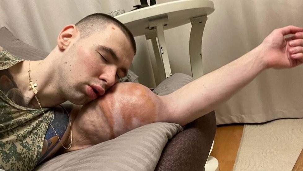 Kiril Těrešin se chystá na komplikované odstranění obrovských „bicepsů“.