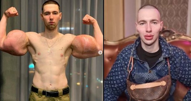 Ruský „Pepek námořník" s napíchanými bicepsy podstoupil další zákrok: Chce vypadat jako mimozemšťan!