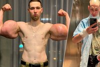 Byl jsem stupidní, přiznal kulturista, který si vpichoval do bicepsů olej. Hrozí mu, že přijde o ruce