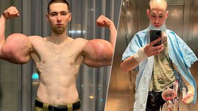 Byl jsem stupidní, přiznal kulturista, který si vpichoval do bicepsů olej. Hrozí mu, že přijde o ruce