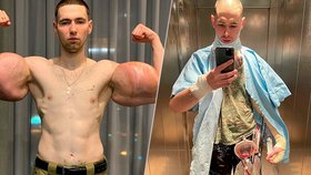 Kirill Tereshin si vpichováním oleje zničil zdraví.