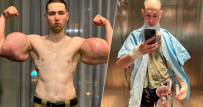 Kirill Tereshin si vpichováním oleje zničil zdraví.