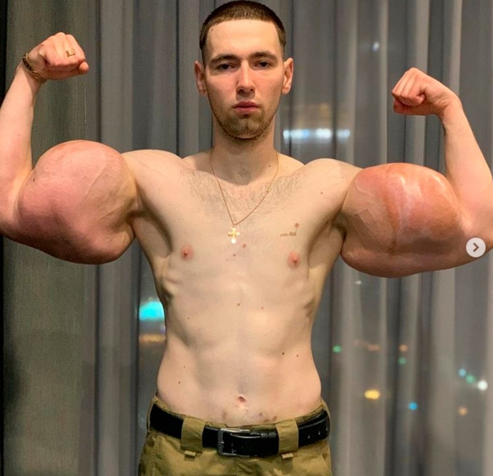 Kiril Těrešin se chystá na komplikované odstranění obrovských „bicepsů“.