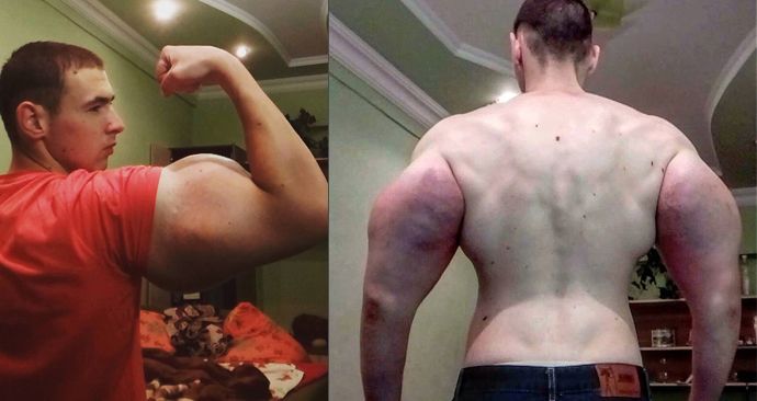 Kirill Tereshin (21) z Ruska si do svalů píchá nebezpečný olej, aby zlomil rekord v kulturistice
