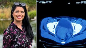 Klára (31) překonala rakovinu děložního čípku