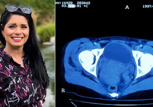Klára (31) překonala rakovinu děložního čípku